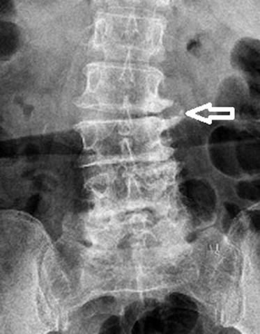 Hình Ảnh Gai Cột Sống Thắt Lưng: Định Nghĩa, Nguyên Nhân, Triệu Chứng & Cách Điều Trị Dành Cho Người Mới Bắt Đầu