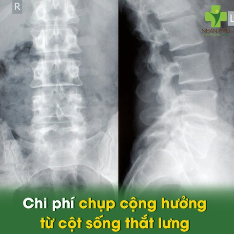 Hình Ảnh Gai Cột Sống Thắt Lưng: Định Nghĩa, Nguyên Nhân, Triệu Chứng & Cách Điều Trị Dành Cho Người Mới Bắt Đầu