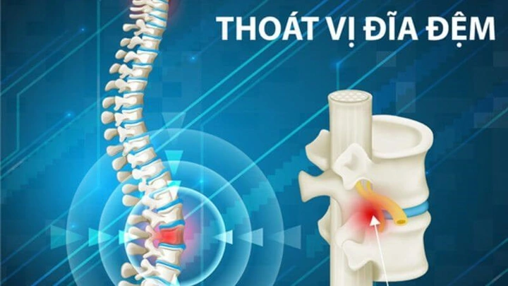 Hình Ảnh Gai Cột Sống Thắt Lưng: Định Nghĩa, Nguyên Nhân, Triệu Chứng & Cách Điều Trị Dành Cho Người Mới Bắt Đầu