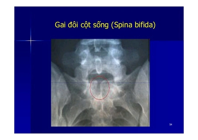 Hình Ảnh Gai Cột Sống Thắt Lưng: Định Nghĩa, Nguyên Nhân, Triệu Chứng & Cách Điều Trị Dành Cho Người Mới Bắt Đầu