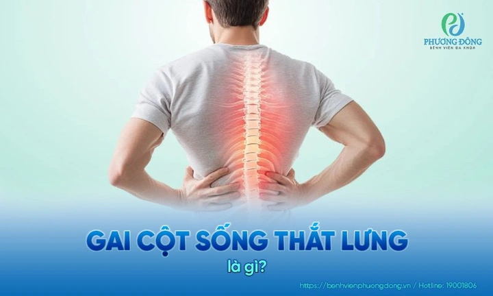 Hình Ảnh Gai Cột Sống Thắt Lưng: Định Nghĩa, Nguyên Nhân, Triệu Chứng & Cách Điều Trị Dành Cho Người Mới Bắt Đầu