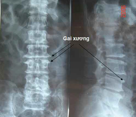 Hình Ảnh Gai Cột Sống Thắt Lưng: Định Nghĩa, Nguyên Nhân, Triệu Chứng & Cách Điều Trị Dành Cho Người Mới Bắt Đầu