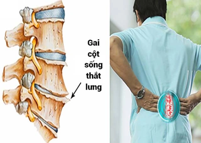 Hình Ảnh Gai Cột Sống Thắt Lưng: Định Nghĩa, Nguyên Nhân, Triệu Chứng & Cách Điều Trị Dành Cho Người Mới Bắt Đầu
