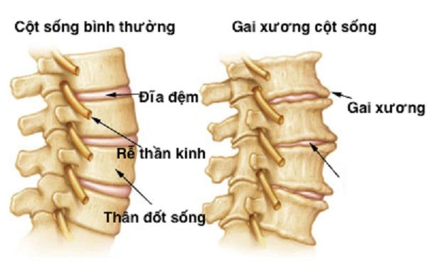 Hình Ảnh Gai Cột Sống Thắt Lưng: Định Nghĩa, Nguyên Nhân, Triệu Chứng & Cách Điều Trị Dành Cho Người Mới Bắt Đầu