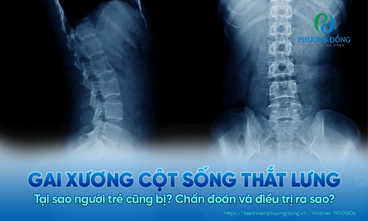 Hình Ảnh Gai Cột Sống Thắt Lưng: Định Nghĩa, Nguyên Nhân, Triệu Chứng & Cách Điều Trị Dành Cho Người Mới Bắt Đầu