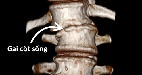 Hình Ảnh Gai Cột Sống Thắt Lưng: Định Nghĩa, Nguyên Nhân, Triệu Chứng & Cách Điều Trị Dành Cho Người Mới Bắt Đầu