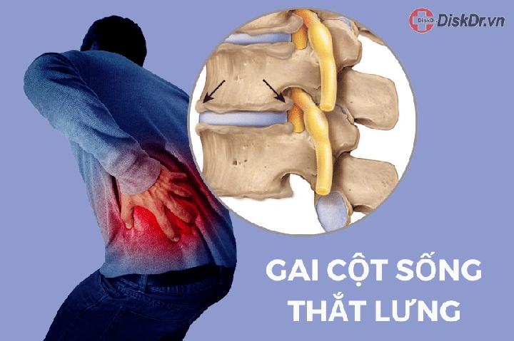 Hình Ảnh Gai Cột Sống Thắt Lưng: Định Nghĩa, Nguyên Nhân, Triệu Chứng & Cách Điều Trị Dành Cho Người Mới Bắt Đầu