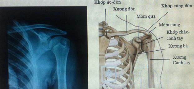 Hình Ảnh Giải Phẫu Khớp Vai: Cấu Trúc Chi Tiết, Bệnh Lý Thường Gặp Và Ứng Dụng Lâm Sàng Cho Sinh Viên Y & Bác Sĩ