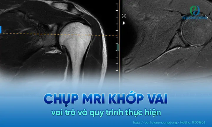 Hình Ảnh Giải Phẫu Khớp Vai: Cấu Trúc Chi Tiết, Bệnh Lý Thường Gặp Và Ứng Dụng Lâm Sàng Cho Sinh Viên Y & Bác Sĩ