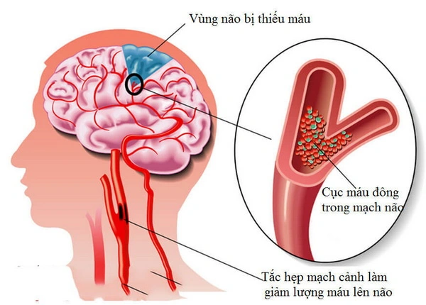 Hình Ảnh Hoa Mắt Chóng Mặt: Tất Cả Những Điều Bạn Cần Biết (dành Cho Người Tìm Kiếm Hình Ảnh & Giải Thích Yếu Tố Y Khoa)