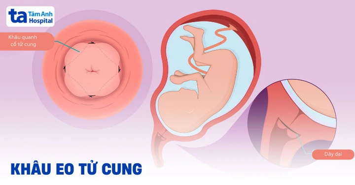Hình Ảnh Màng Trinh Dày: Cách Nhận Biết, Đánh Giá Và Xử Trợ Cho Các Bạn Trẻ (đối Tượng Nữ Tuổi Teen‑teen)