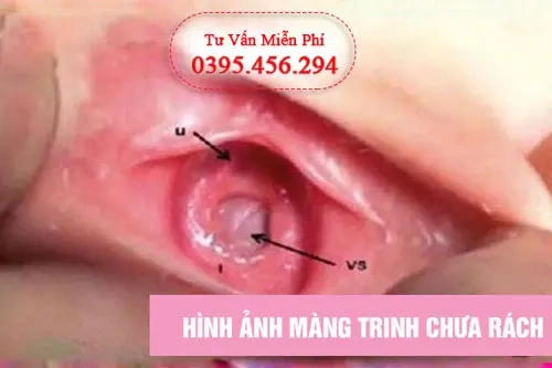 Hình Ảnh Màng Trinh Dày: Cách Nhận Biết, Đánh Giá Và Xử Trợ Cho Các Bạn Trẻ (đối Tượng Nữ Tuổi Teen‑teen)