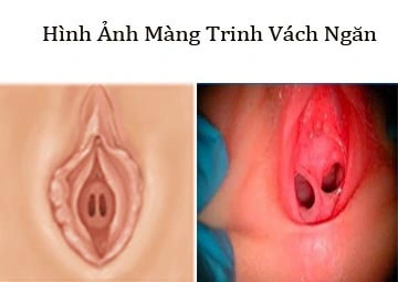 Hình Ảnh Màng Trinh Dày: Cách Nhận Biết, Đánh Giá Và Xử Trợ Cho Các Bạn Trẻ (đối Tượng Nữ Tuổi Teen‑teen)