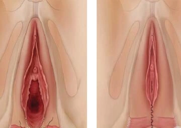 Hình Ảnh Màng Trinh Dày: Cách Nhận Biết, Đánh Giá Và Xử Trợ Cho Các Bạn Trẻ (đối Tượng Nữ Tuổi Teen‑teen)