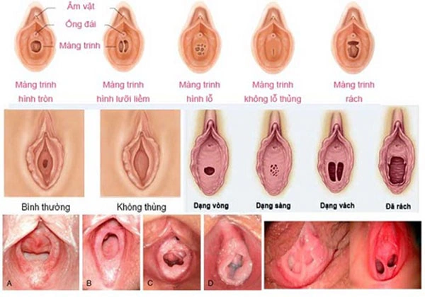 Hình Ảnh Màng Trinh Dày: Cách Nhận Biết, Đánh Giá Và Xử Trợ Cho Các Bạn Trẻ (đối Tượng Nữ Tuổi Teen‑teen)