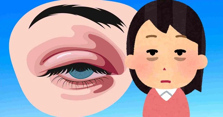 100+ Hình Ảnh Mắt Sưng Húp 2026 - Bộ Sưu Tập Đầy Đủ Cho Mọi Nhu Cầu 100+ Hình Ảnh Mắt Sưng Húp 2026 - Bộ Sưu Tập Đầy Đủ Cho Mọi Nhu Cầu