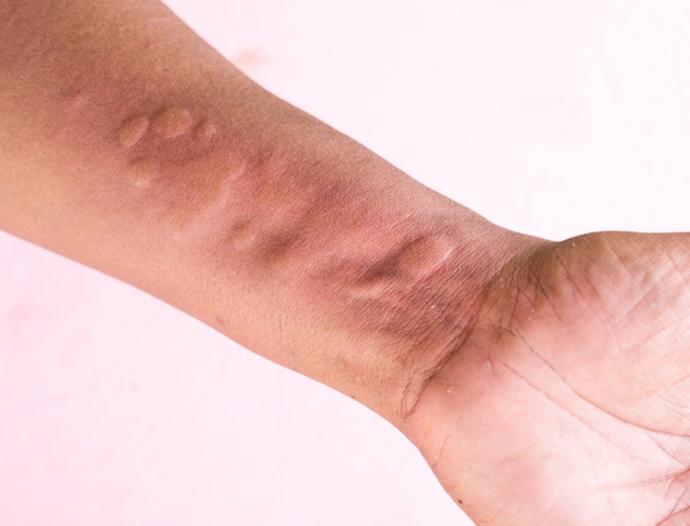 Hình Ảnh Người Bị Nhiễm Hiv/aids: Nhận Dạng, Triệu Chứng & Phân Biệt Đúng Đối Tượng