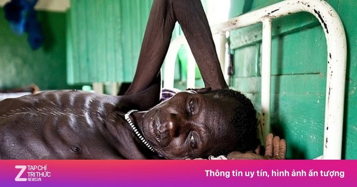 Hình Ảnh Người Bị Nhiễm Hiv/aids: Nhận Dạng, Triệu Chứng & Phân Biệt Đúng Đối Tượng