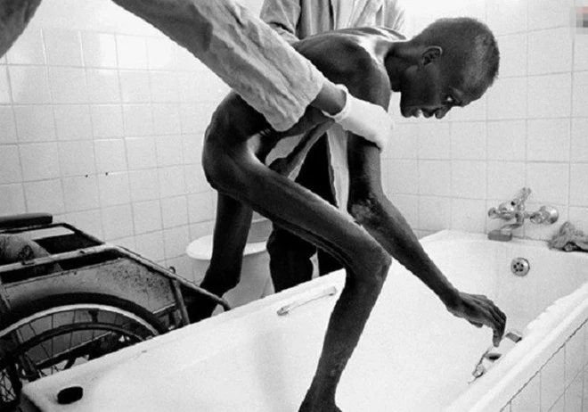 Hình Ảnh Người Bị Nhiễm Hiv/aids: Nhận Dạng, Triệu Chứng & Phân Biệt Đúng Đối Tượng