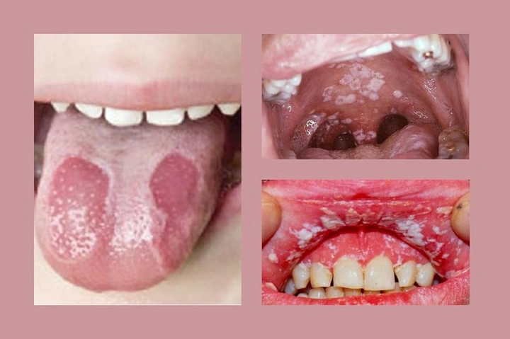 Hình Ảnh Người Bị Nhiễm Hiv/aids: Nhận Dạng, Triệu Chứng & Phân Biệt Đúng Đối Tượng