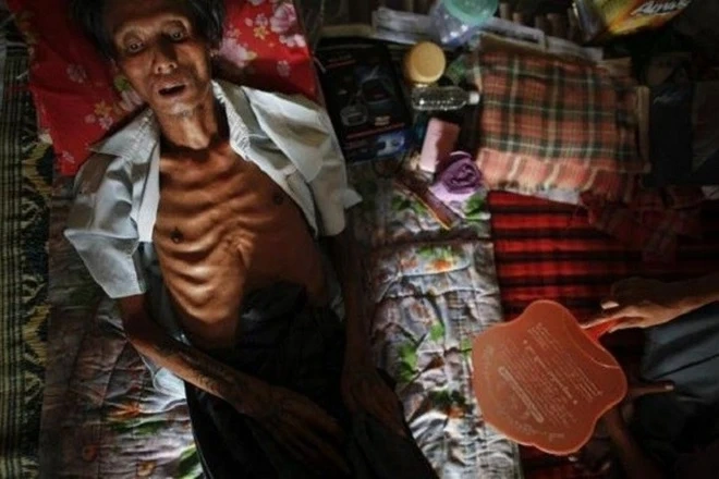 Hình Ảnh Người Bị Nhiễm Hiv/aids: Nhận Dạng, Triệu Chứng & Phân Biệt Đúng Đối Tượng