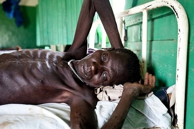 Hình Ảnh Người Bị Nhiễm Hiv/aids: Nhận Dạng, Triệu Chứng & Phân Biệt Đúng Đối Tượng