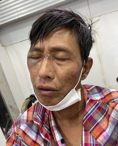 Hình Ảnh Người Bị Nhiễm Hiv/aids: Nhận Dạng, Triệu Chứng & Phân Biệt Đúng Đối Tượng