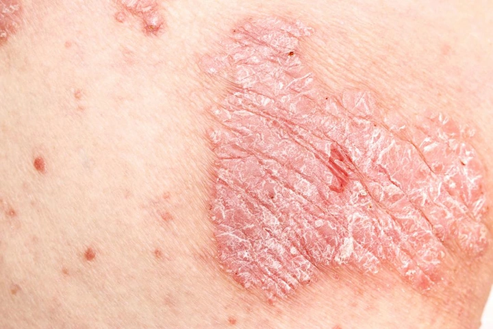 Hình Ảnh Người Bị Nhiễm Hiv/aids: Nhận Dạng, Triệu Chứng & Phân Biệt Đúng Đối Tượng