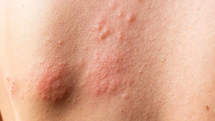 Hình Ảnh Người Bị Nhiễm Hiv/aids: Nhận Dạng, Triệu Chứng & Phân Biệt Đúng Đối Tượng