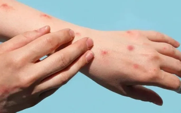 Hình Ảnh Người Bị Nhiễm Hiv/aids: Nhận Dạng, Triệu Chứng & Phân Biệt Đúng Đối Tượng