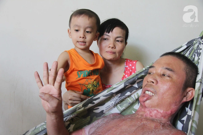 Hình Ảnh Người Bị Điện Giật: Cách Nhận Biết, Sơ Cứu Và Phòng Ngừa – Dành Cho Người Dân Và Nhân Viên Cứu Hộ
