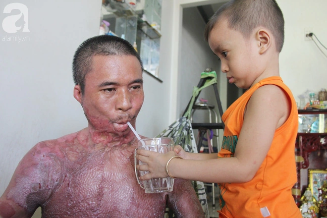 Hình Ảnh Người Bị Điện Giật: Cách Nhận Biết, Sơ Cứu Và Phòng Ngừa – Dành Cho Người Dân Và Nhân Viên Cứu Hộ