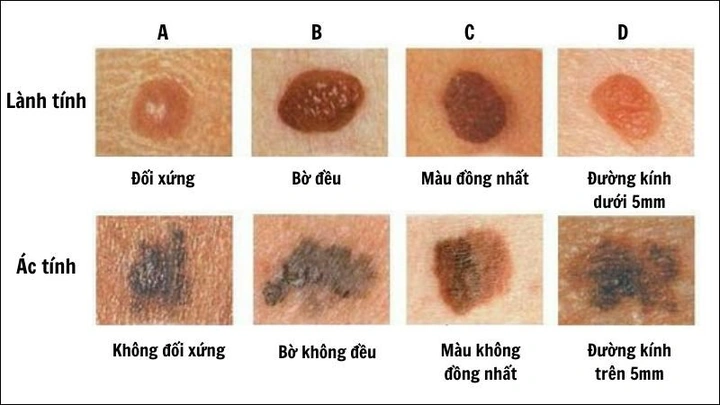 Hình Ảnh Nốt Ruồi Bình Thường: Cách Nhận Biết & Phân Biệt Với Nốt Ruồi Ung Thư