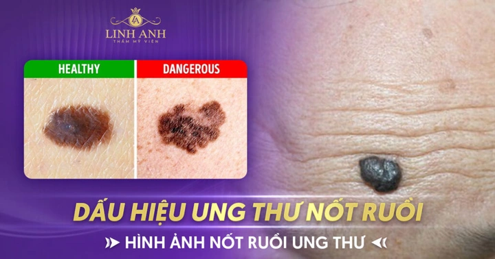 Hình Ảnh Nốt Ruồi Bình Thường: Cách Nhận Biết & Phân Biệt Với Nốt Ruồi Ung Thư