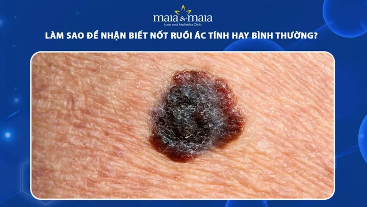 Hình Ảnh Nốt Ruồi Bình Thường: Cách Nhận Biết & Phân Biệt Với Nốt Ruồi Ung Thư