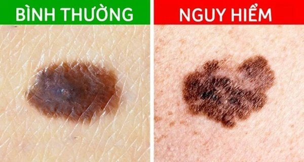 Hình Ảnh Nốt Ruồi Bình Thường: Cách Nhận Biết & Phân Biệt Với Nốt Ruồi Ung Thư
