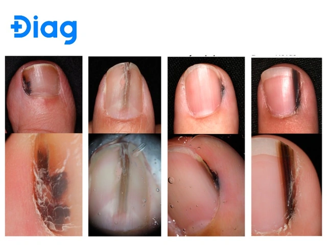 Hình Ảnh Nốt Ruồi Bình Thường: Cách Nhận Biết & Phân Biệt Với Nốt Ruồi Ung Thư