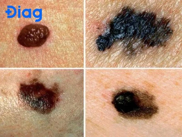 Hình Ảnh Nốt Ruồi Bình Thường: Cách Nhận Biết & Phân Biệt Với Nốt Ruồi Ung Thư