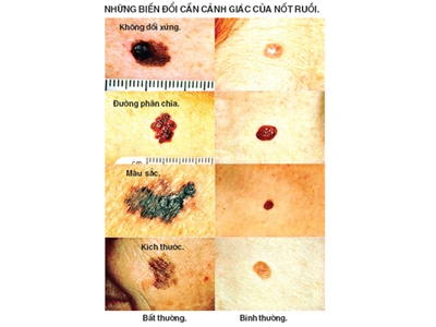 Hình Ảnh Nốt Ruồi Bình Thường: Cách Nhận Biết & Phân Biệt Với Nốt Ruồi Ung Thư