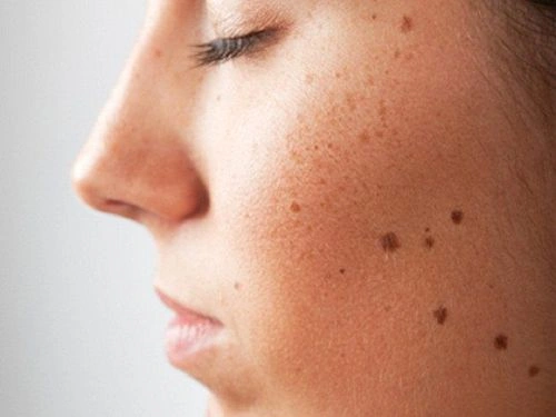 Hình Ảnh Nốt Ruồi Bình Thường: Cách Nhận Biết & Phân Biệt Với Nốt Ruồi Ung Thư