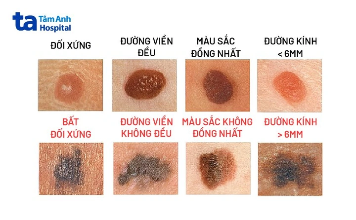 Hình Ảnh Nốt Ruồi Bình Thường: Cách Nhận Biết & Phân Biệt Với Nốt Ruồi Ung Thư