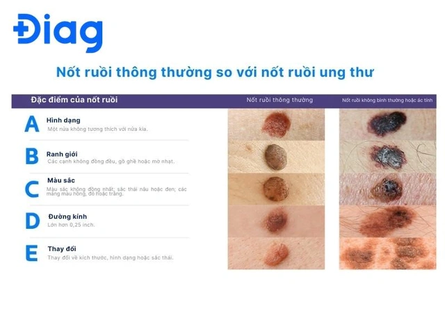 Hình Ảnh Nốt Ruồi Bình Thường: Cách Nhận Biết & Phân Biệt Với Nốt Ruồi Ung Thư
