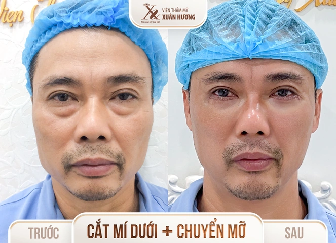 Hình Ảnh Phẫu Thuật Thẩm Mỹ Trước Sau: Tổng Hợp Kết Quả Thành Công Và Thất Bại Cho Người Quan Tâm Hình Ảnh Phẫu Thuật Thẩm Mỹ Trước Sau: Tổng Hợp Kết Quả Thành Công Và Thất Bại Cho Người Quan Tâm