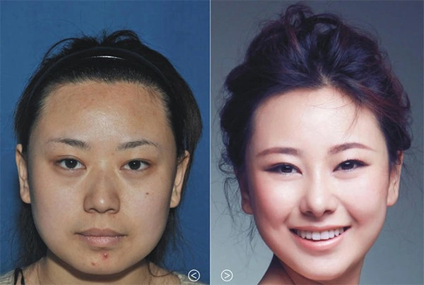 Hình Ảnh Phẫu Thuật Thẩm Mỹ Trước Sau: Tổng Hợp Kết Quả Thành Công Và Thất Bại Cho Người Quan Tâm Hình Ảnh Phẫu Thuật Thẩm Mỹ Trước Sau: Tổng Hợp Kết Quả Thành Công Và Thất Bại Cho Người Quan Tâm