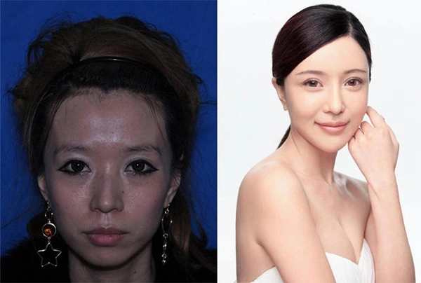 Hình Ảnh Phẫu Thuật Thẩm Mỹ Trước Sau: Tổng Hợp Kết Quả Thành Công Và Thất Bại Cho Người Quan Tâm Hình Ảnh Phẫu Thuật Thẩm Mỹ Trước Sau: Tổng Hợp Kết Quả Thành Công Và Thất Bại Cho Người Quan Tâm