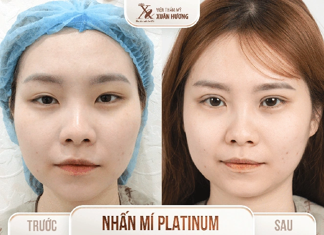 Hình Ảnh Phẫu Thuật Thẩm Mỹ Trước Sau: Tổng Hợp Kết Quả Thành Công Và Thất Bại Cho Người Quan Tâm Hình Ảnh Phẫu Thuật Thẩm Mỹ Trước Sau: Tổng Hợp Kết Quả Thành Công Và Thất Bại Cho Người Quan Tâm