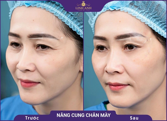 Hình Ảnh Phẫu Thuật Thẩm Mỹ Trước Sau: Tổng Hợp Kết Quả Thành Công Và Thất Bại Cho Người Quan Tâm Hình Ảnh Phẫu Thuật Thẩm Mỹ Trước Sau: Tổng Hợp Kết Quả Thành Công Và Thất Bại Cho Người Quan Tâm