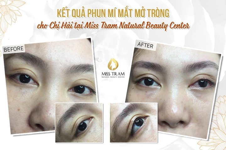 Xem Hình Ảnh Phun Mí Mở Tròng Đẹp Nhất: Bộ Sưu Tập Thực Tế & Hướng Dẫn Cho Người Muốn Tăng Độ Sắc Nét Xem Hình Ảnh Phun Mí Mở Tròng Đẹp Nhất: Bộ Sưu Tập Thực Tế & Hướng Dẫn Cho Người Muốn Tăng Độ Sắc Nét