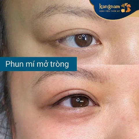 Xem Hình Ảnh Phun Mí Mở Tròng Đẹp Nhất: Bộ Sưu Tập Thực Tế & Hướng Dẫn Cho Người Muốn Tăng Độ Sắc Nét Xem Hình Ảnh Phun Mí Mở Tròng Đẹp Nhất: Bộ Sưu Tập Thực Tế & Hướng Dẫn Cho Người Muốn Tăng Độ Sắc Nét