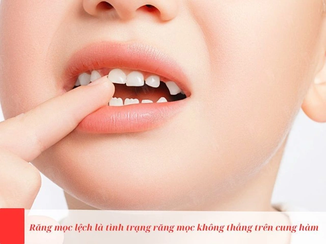 100+ Hình Ảnh Răng Mọc Lệch 2026 - Bộ Sưu Tập Đẹp Nhất, Đầy Đủ Cho Mọi Nhu Cầu? 100+ Hình Ảnh Răng Mọc Lệch 2026 - Bộ Sưu Tập Đẹp Nhất, Đầy Đủ Cho Mọi Nhu Cầu?